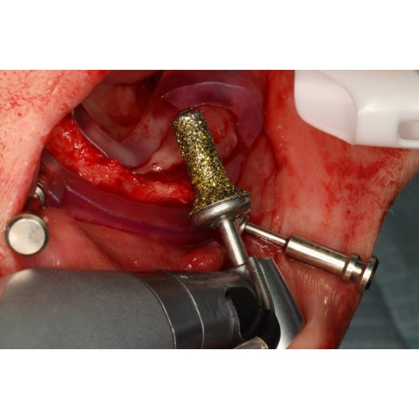 Fraise crestotome diamantée pour contre-angle