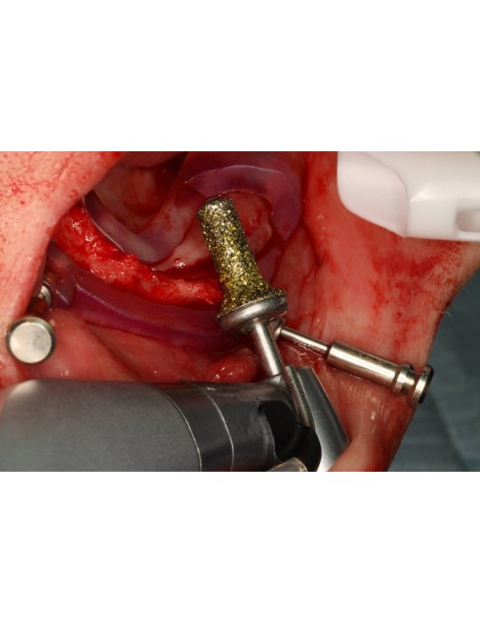 Fraise crestotome diamantée pour contre-angle