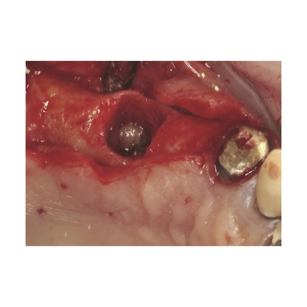 Fraises de dégranulation pour contre-angle Ø 3mm