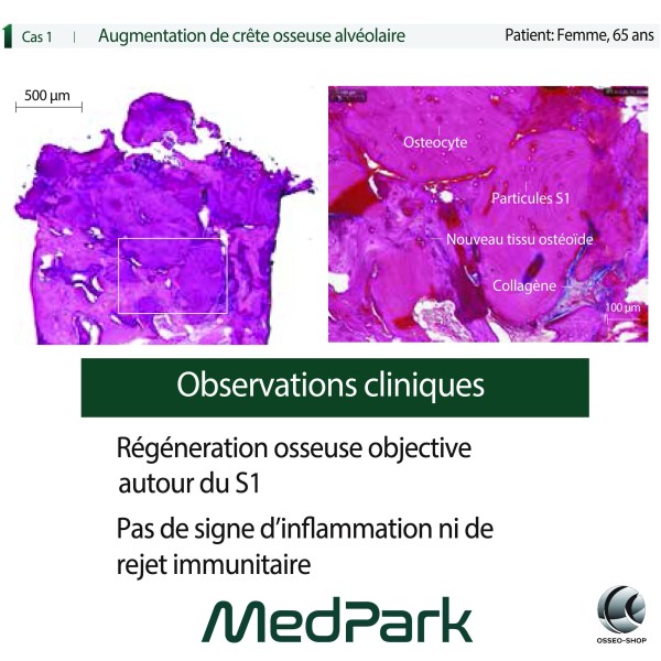 S1 - Substitut osseux "STICKY BONE" origine bovine