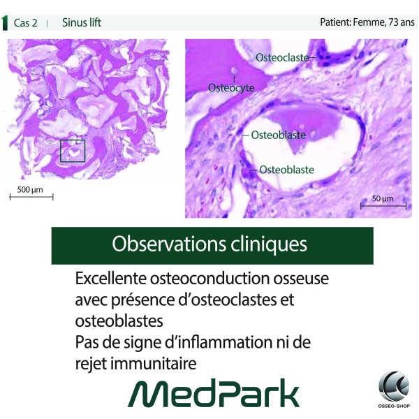 S1 - Substitut osseux "STICKY BONE" origine bovine