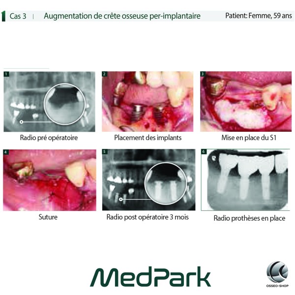 S1 - Substitut osseux "STICKY BONE" origine bovine