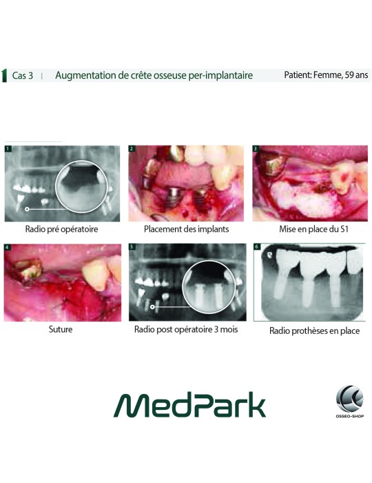 S1 - Substitut osseux "STICKY BONE" origine bovine