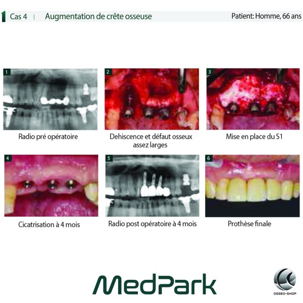 S1 - Substitut osseux "STICKY BONE" origine bovine