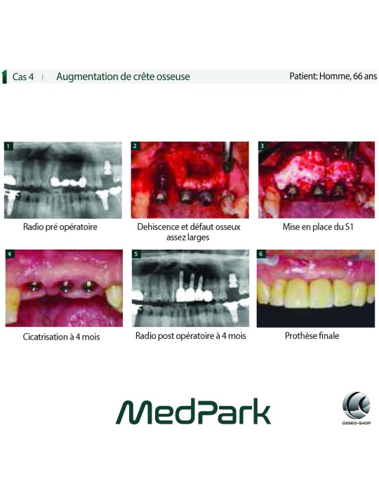 S1 - Substitut osseux "STICKY BONE" origine bovine