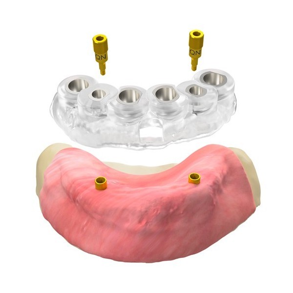 Broche de référence pour chirurgie guidée, QN/L7/d2.9/C4.6 (GS)