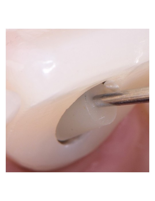 SilverPlug – bouchon antibactérien de scellement de puit de vis