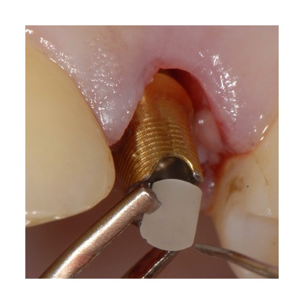 SilverPlug – bouchon antibactérien de scellement de puit de vis