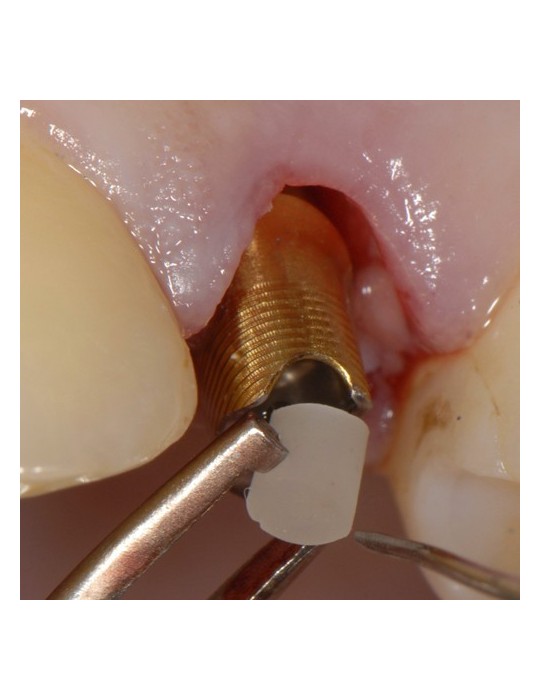 SilverPlug – bouchon antibactérien de scellement de puit de vis