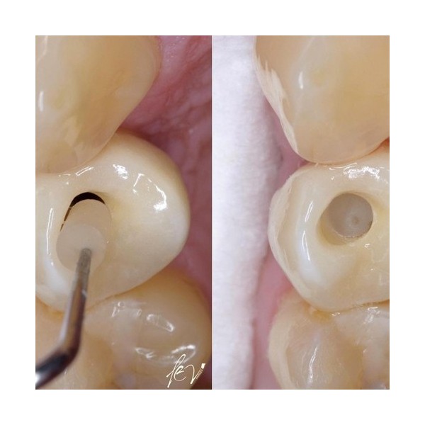 SilverPlug – bouchon antibactérien de scellement de puit de vis