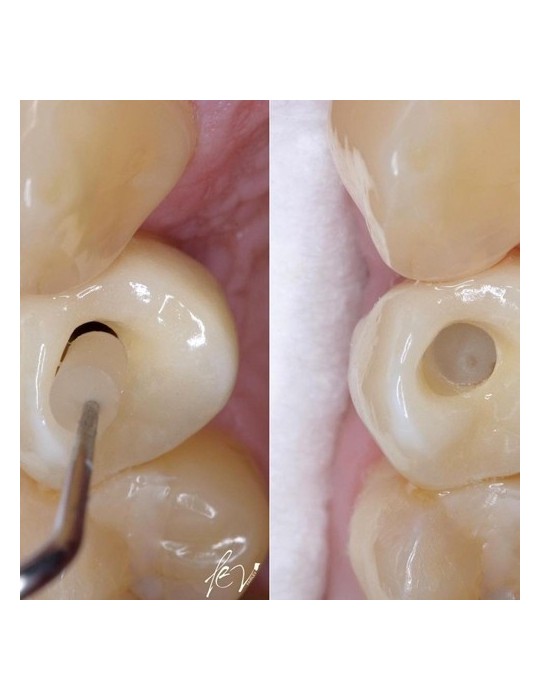 SilverPlug – bouchon antibactérien de scellement de puit de vis