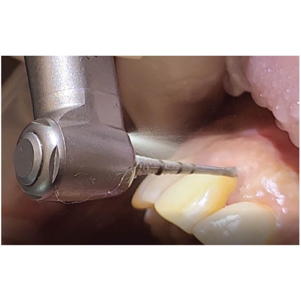 Kit de préparation radiculaire parodontale