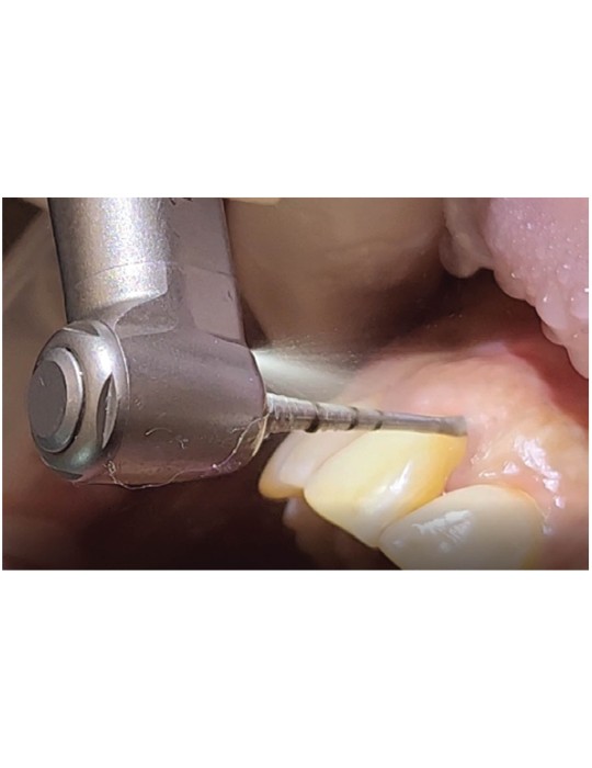 Kit de préparation radiculaire parodontale