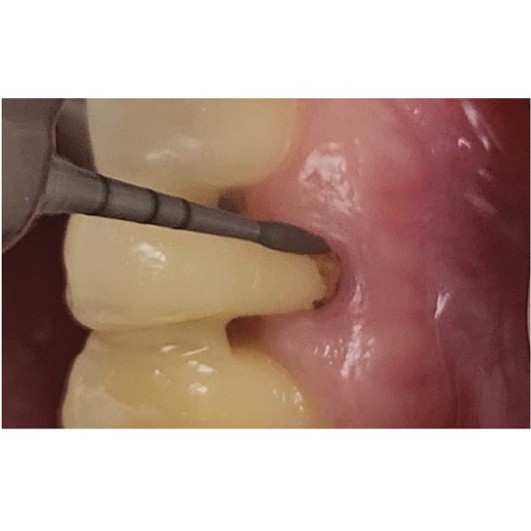 Kit de préparation radiculaire parodontale