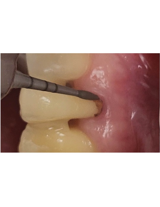 Kit de préparation radiculaire parodontale