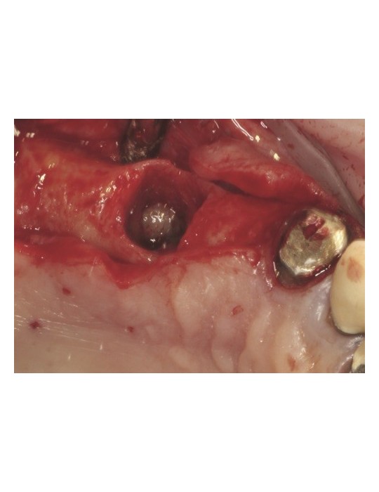 Kit de dégranulation - 5 fraises