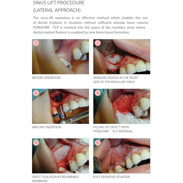 Beta-TCP Lasak Poresorb-TCP - Biomatériaux