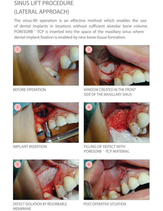Beta-TCP Lasak Poresorb-TCP - Biomatériaux