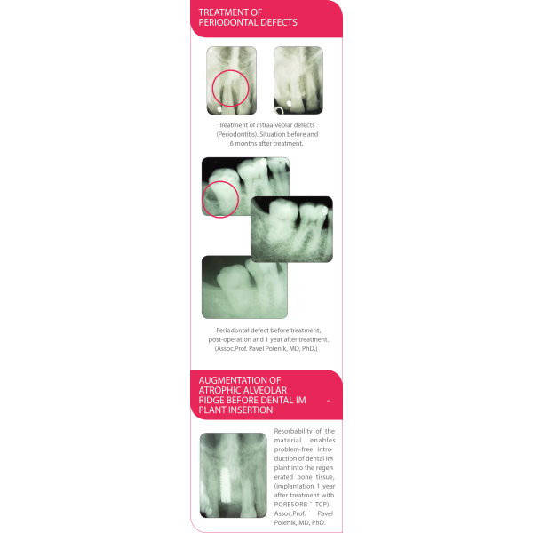 Beta-TCP Lasak Poresorb-TCP - Biomatériaux