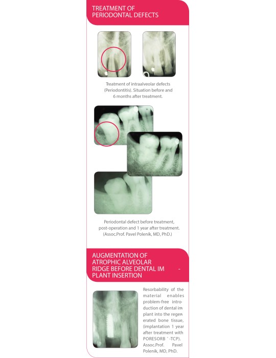 Beta-TCP Lasak Poresorb-TCP - Biomatériaux