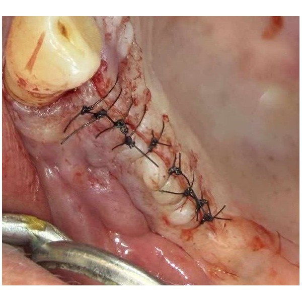 32.90€ les 12 Sutures Nylon - Non Résorbable Monofilament