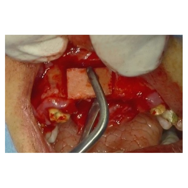 Pinces à greffons osseux - MJK