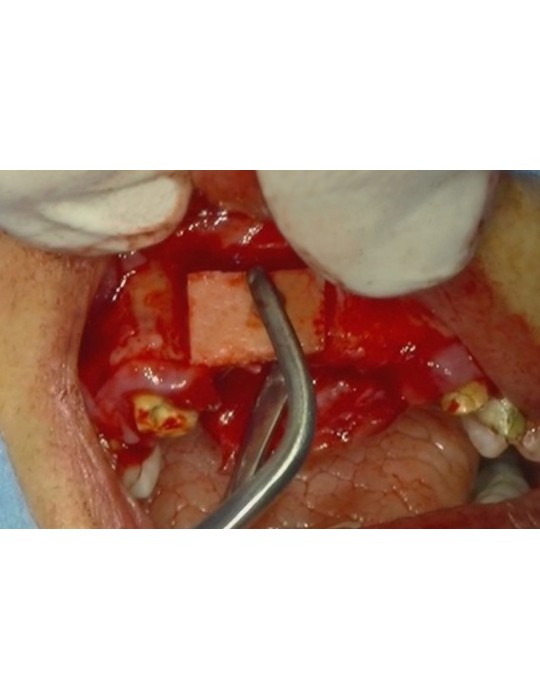 Pinces à greffons osseux - MJK