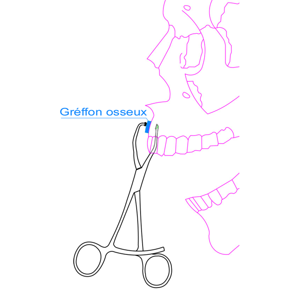 Pinces à greffons osseux - MJK