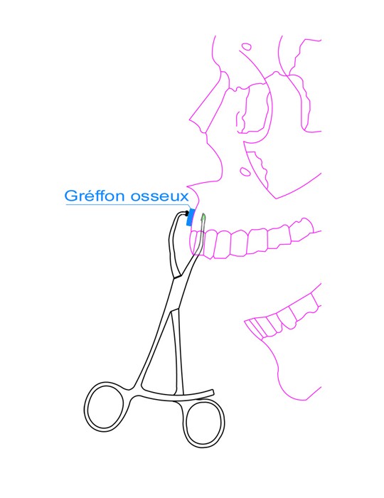 Pinces à greffons osseux - MJK