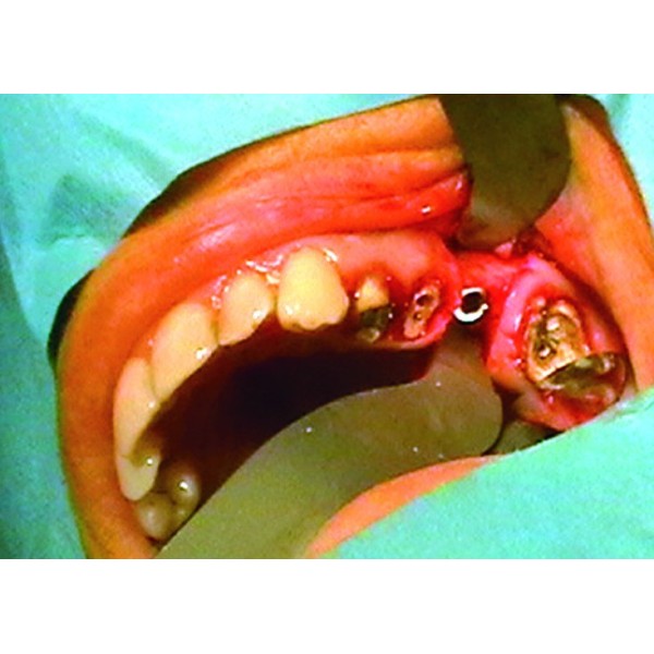 ÉCARTEURS MODELBALES « Surgy’ Soft » - MJK