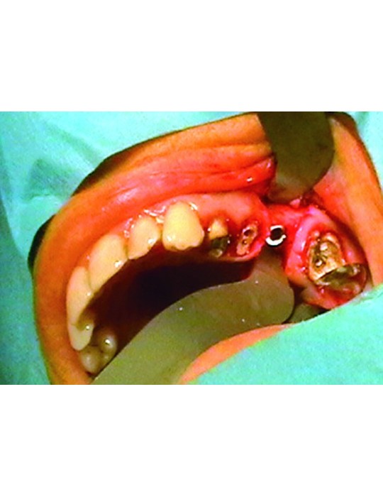 ÉCARTEURS MODELBALES « Surgy’ Soft » - MJK