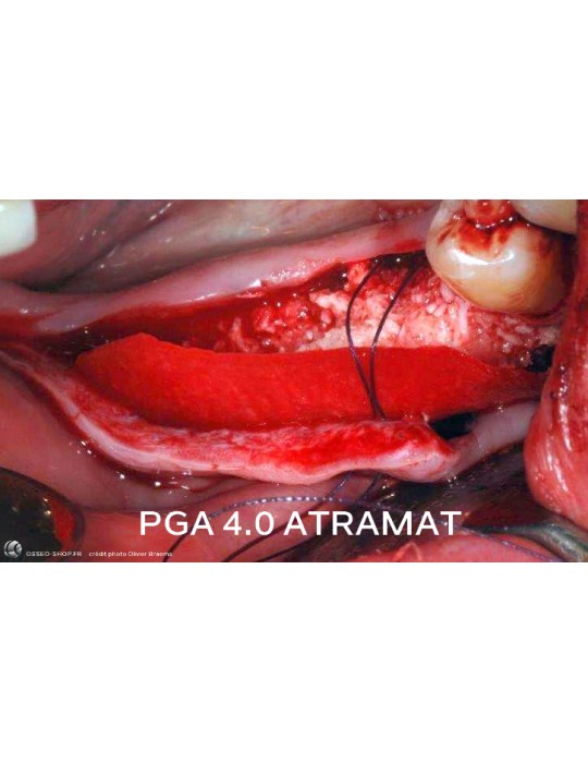 50.90€ - Boîte de 12 Sutures PGA - Résorbable Tressé