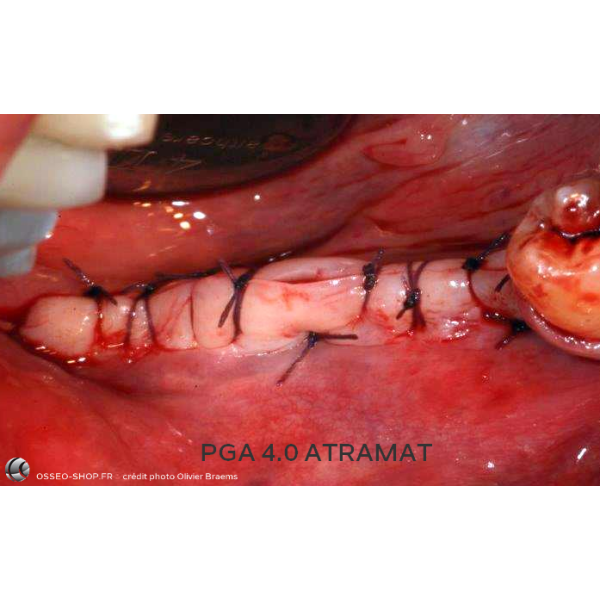 50.90€ - Boîte de 12 Sutures PGA - Résorbable Tressé