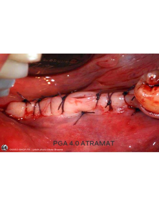 50.90€ - Boîte de 12 Sutures PGA - Résorbable Tressé