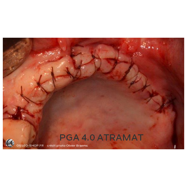 50.90€ - Boîte de 12 Sutures PGA - Résorbable Tressé