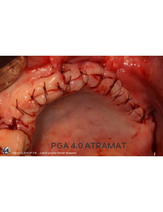 50.90€ - Boîte de 12 Sutures PGA - Résorbable Tressé