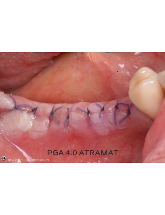 50.90€ - Boîte de 12 Sutures PGA - Résorbable Tressé