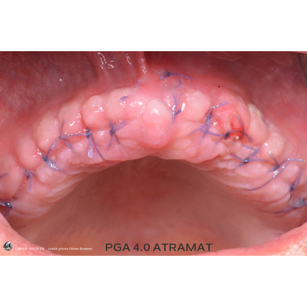 50.90€ - Boîte de 12 Sutures PGA - Résorbable Tressé