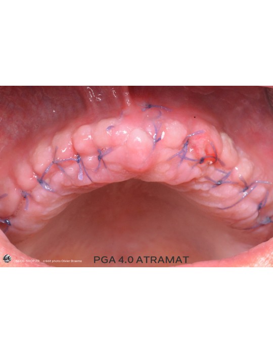 50.90€ - Boîte de 12 Sutures PGA - Résorbable Tressé