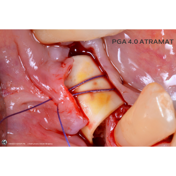 50.90€ - Boîte de 12 Sutures PGA - Résorbable Tressé