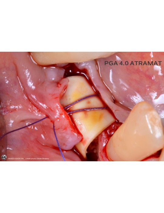 50.90€ - Boîte de 12 Sutures PGA - Résorbable Tressé