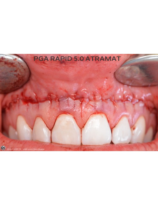 52.90€ - Boîte de 12 Sutures PGA RAPID - Résorbable Rapide Tressé