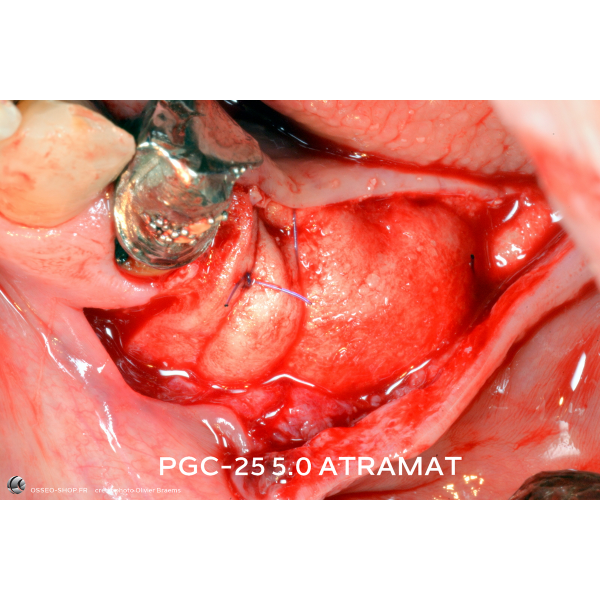 43.90€ - Boîte de 12 Sutures PGC25 - Résorbable Monofilament