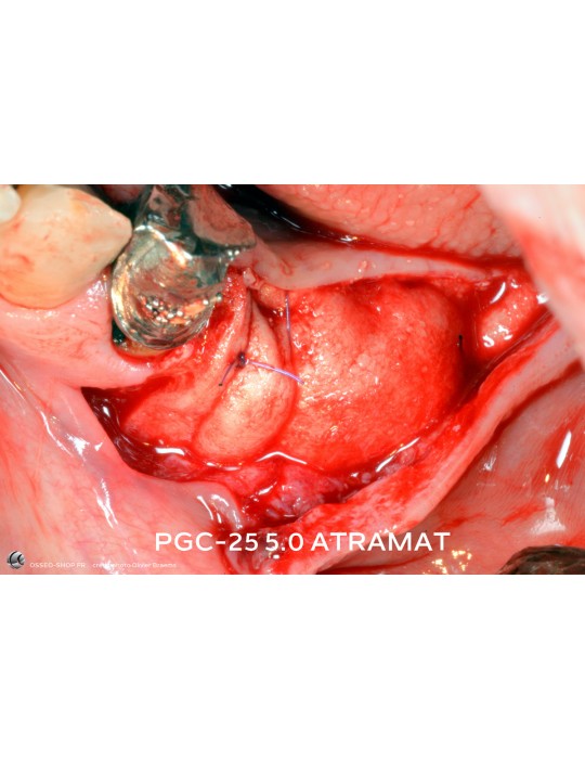 43.90€ - Boîte de 12 Sutures PGC25 - Résorbable Monofilament