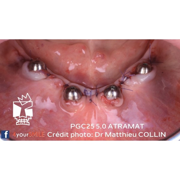 43.90€ - Boîte de 12 Sutures PGC25 - Résorbable Monofilament