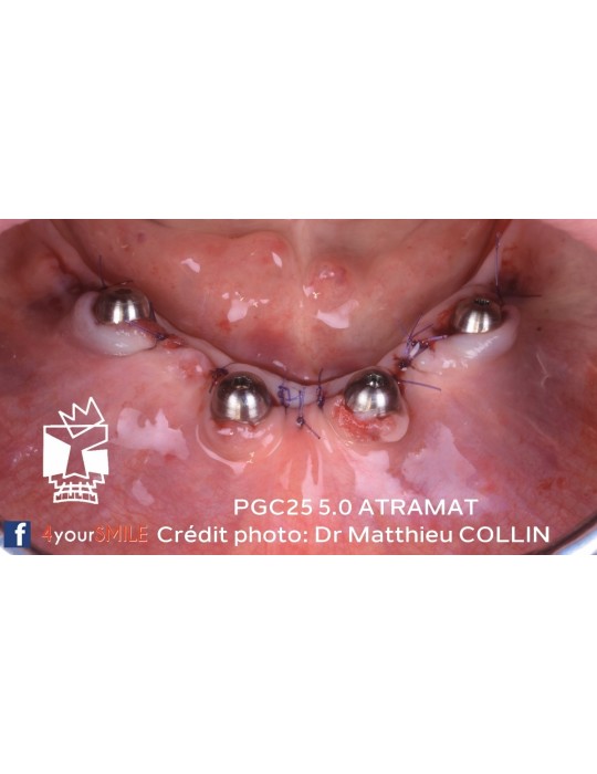 43.90€ - Boîte de 12 Sutures PGC25 - Résorbable Monofilament