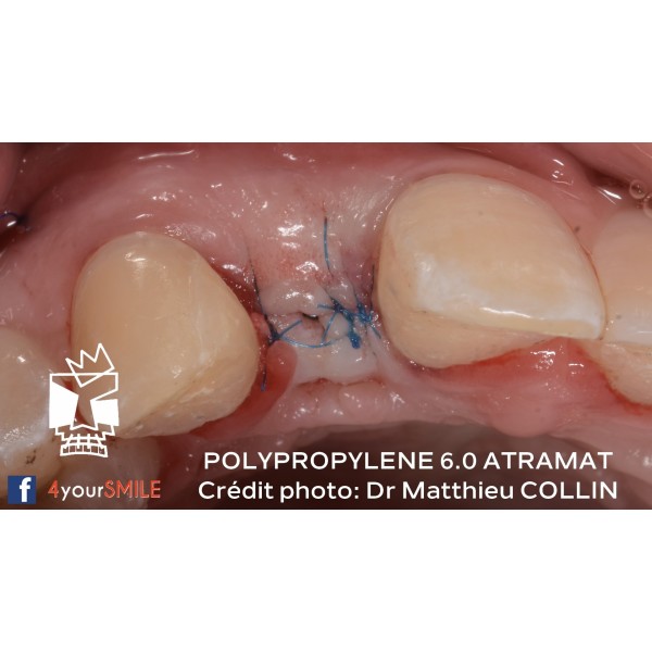 42.90€ les 12 Sutures Polypropylene - Non Résorbable Monofilament