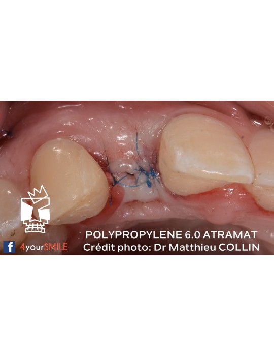 42.90€ les 12 Sutures Polypropylene - Non Résorbable Monofilament