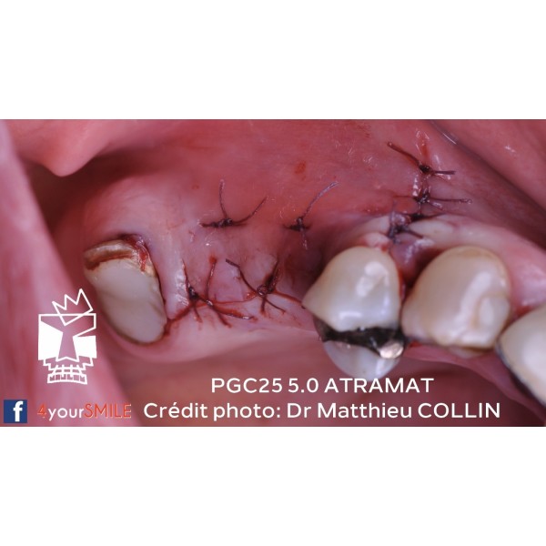 43.90€ - Boîte de 12 Sutures PGC25 - Résorbable Monofilament