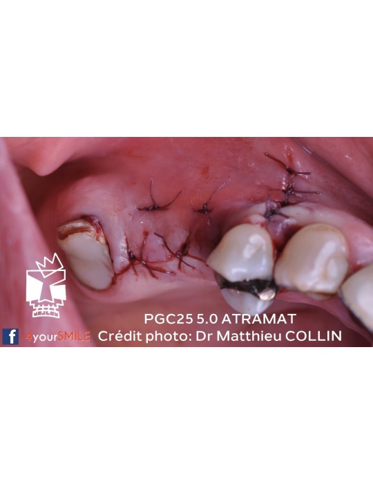 43.90€ - Boîte de 12 Sutures PGC25 - Résorbable Monofilament